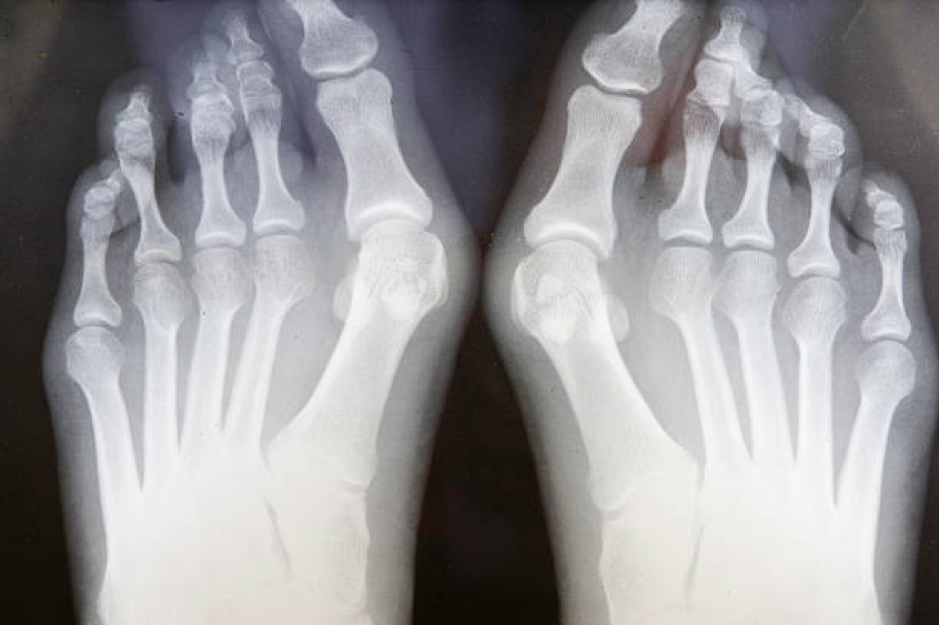 Bunion Surgery and Treatment in Singapore 02