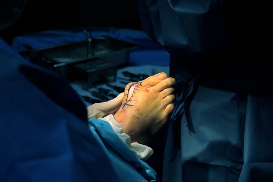 Bunion Surgery and Treatment in Singapore